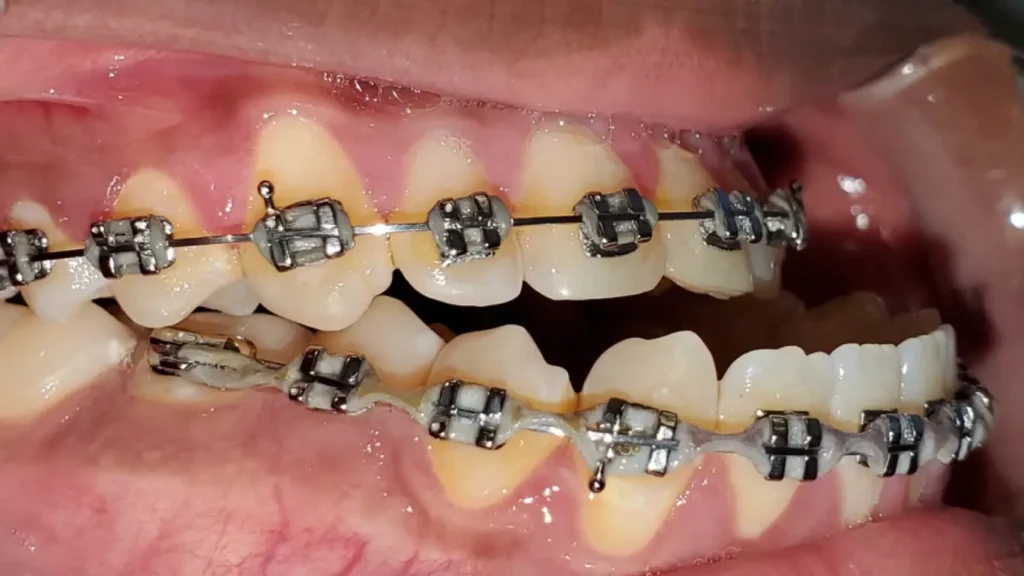 Orthodontic Treatment for Underbite