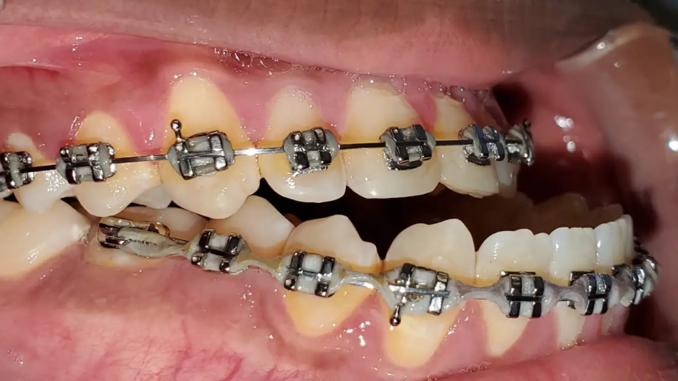 Orthodontic Treatment for Underbite