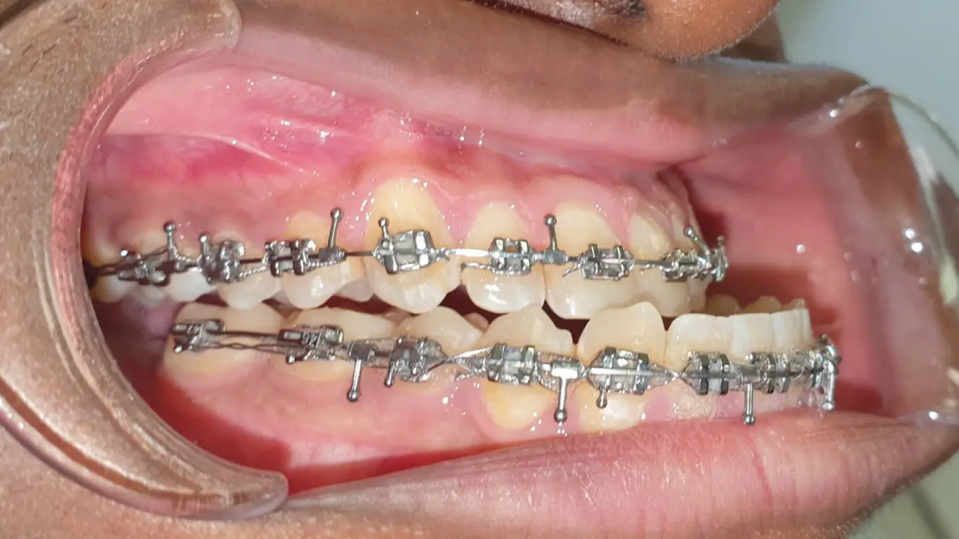 how to fix underbite naturally