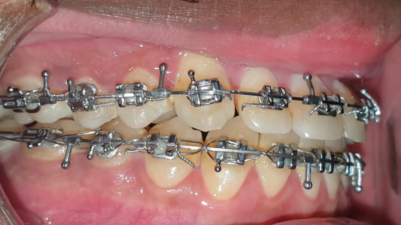 how to treat underbite with braces