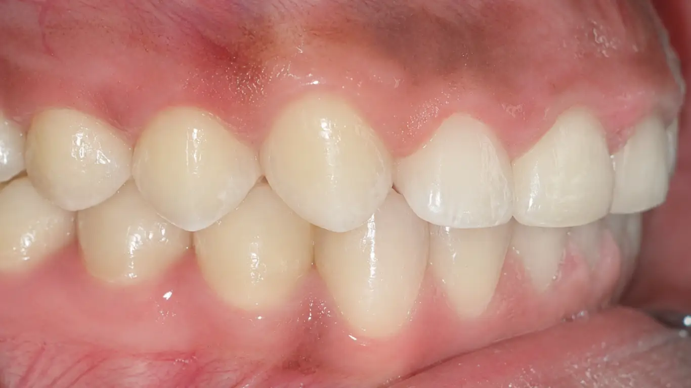 orthodontic treatment for overbite-after