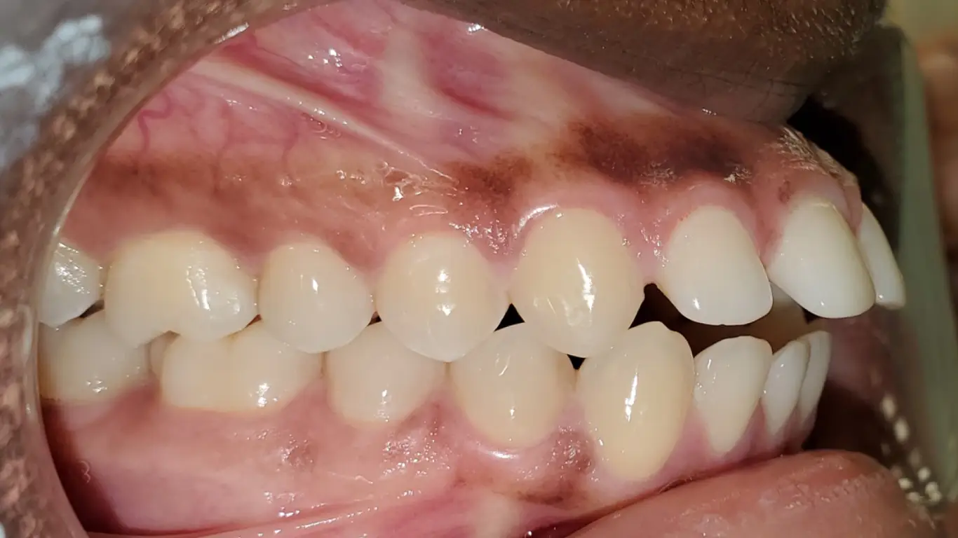 orthodontic treatment for overbite-before