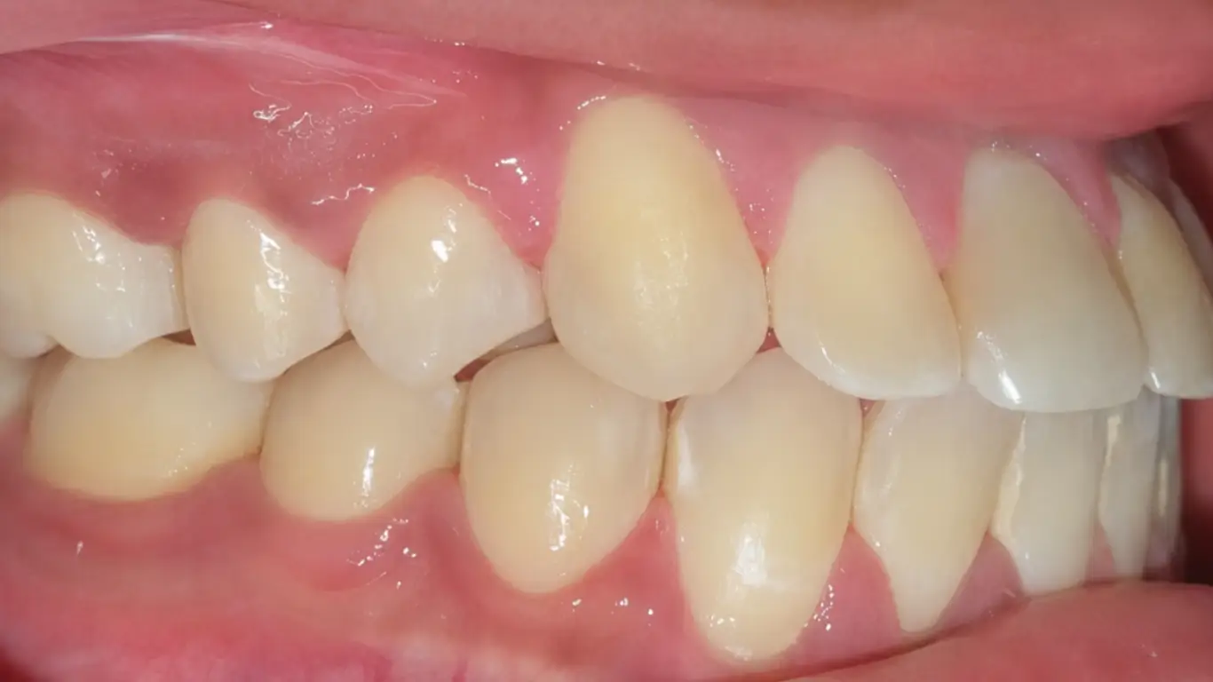 underbite correction