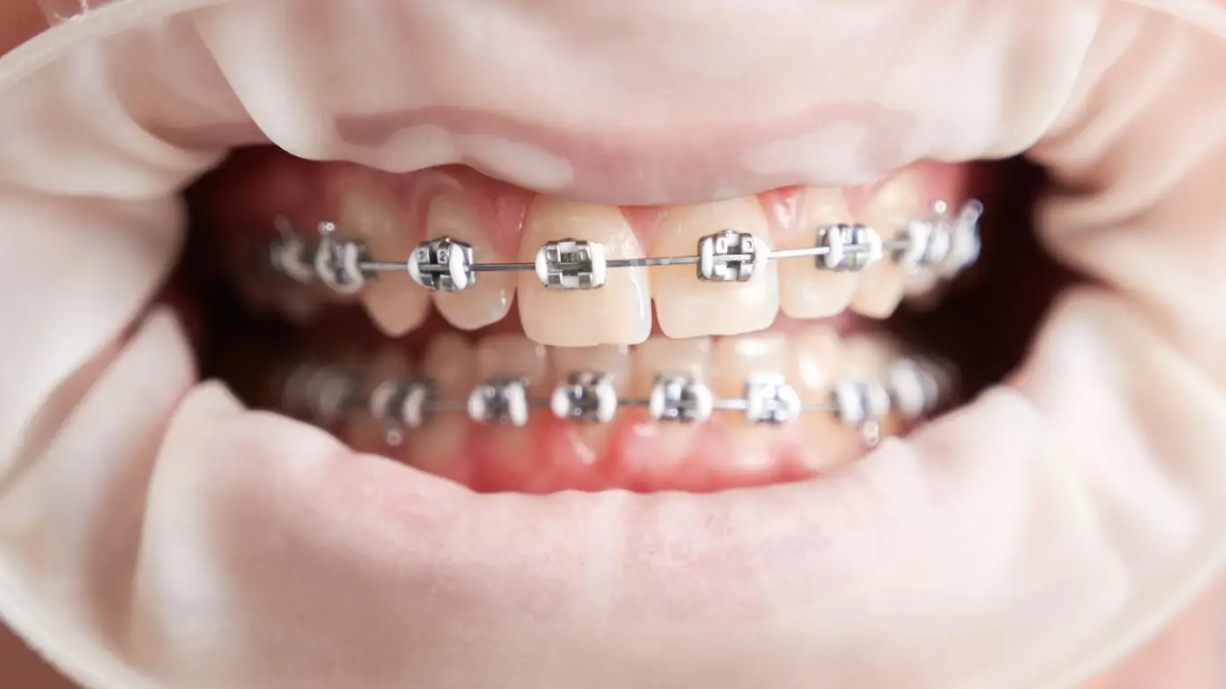 braces for teeth
