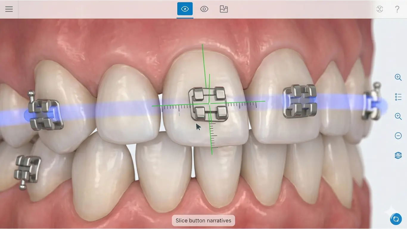 Digital Bracket Placement